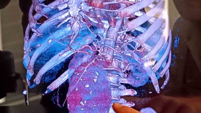 SAMSUN’DA TÜM VÜCUDA KAN POMPALAYAN ANA DAMARI NORMALİN 3 KATI