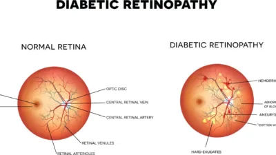 Diyabet hastalarında en sık görülen ve tedavi edilmediğinde kalıcı görme