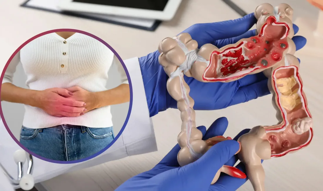 Kolon Kanseri 45 Yaş Altına İndi: Erken Tanı Hayat Kurtarıyor Genetik faktörler, obezite, düzensiz beslenme, sigara ve hareketsiz yaşam tarzı